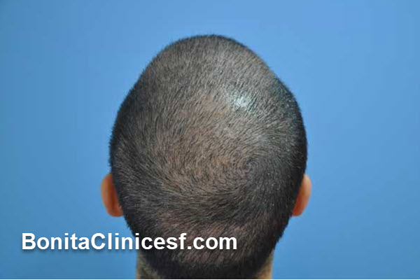 چرا انتخاب بزرگترین مرکز کاشت مو در ایران اهمیت دارد؟