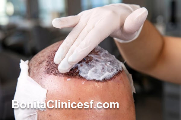 چه زمانی نتیجه کاشت مو مشخص میشود؟