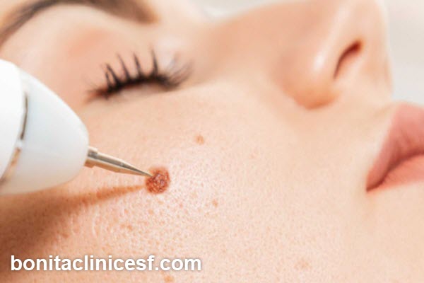 هزینه برداشتن خال معمولی چقدر است؟