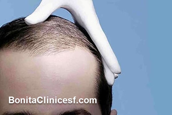 بزرگترین مرکز کاشت مو در ایران