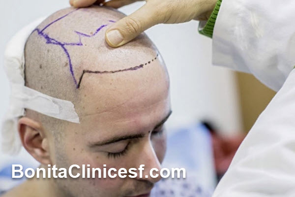 کاشت موی طبیعی در اصفهان