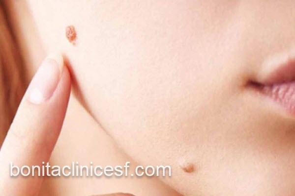 بهترین مرکز خالبرداری ویژه اصفهانی ها | کلینیک بنیتا اصفهان