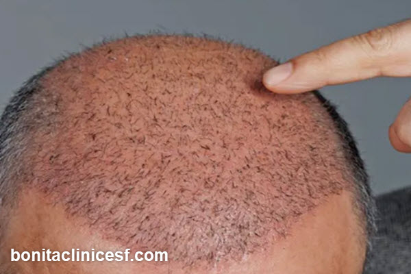 تفاوت کاشت مو با روش های درمانی دیگر