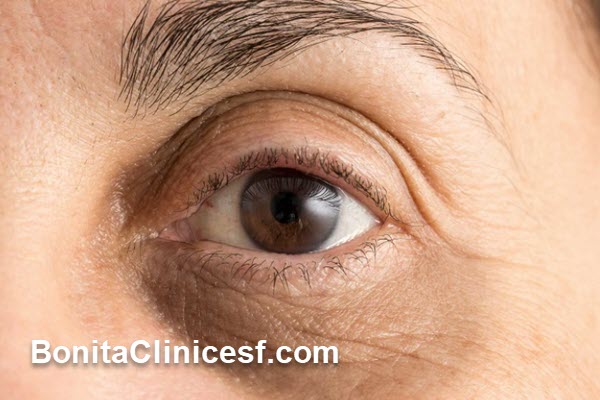 هزینه هایفوتراپی دور چشم چقدر است؟