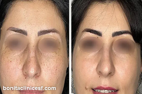 نتایج قابل انتظار پس از استفاده از لیزر کیوسوئیچ