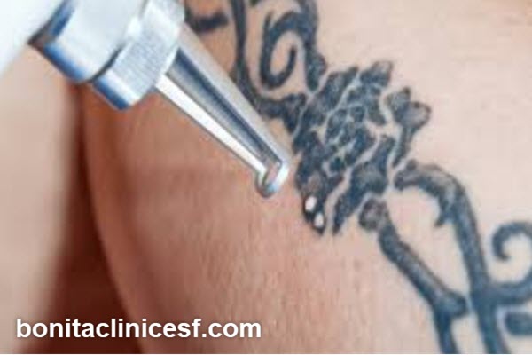 نکات مهم در انتخاب مرکز لیزر تاتو