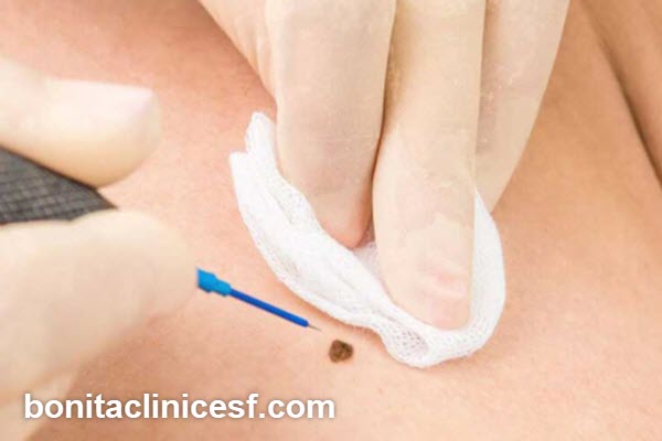 مراقبت های پس از برداشتن خال و زگیل