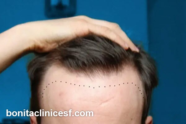 عوامل موثر بر هزینه کاشت مو در شقیقه