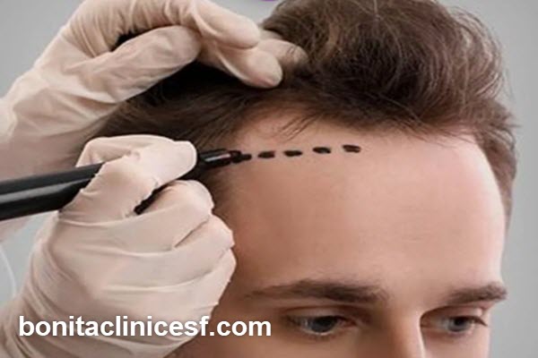 مراقبت های پس از کاشت شقیقه