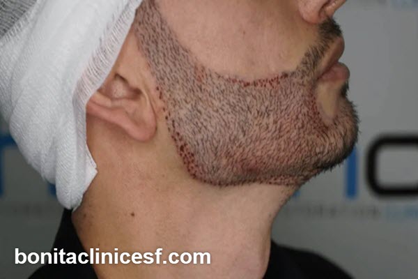مراقبت های قبل و بعد از کاشت