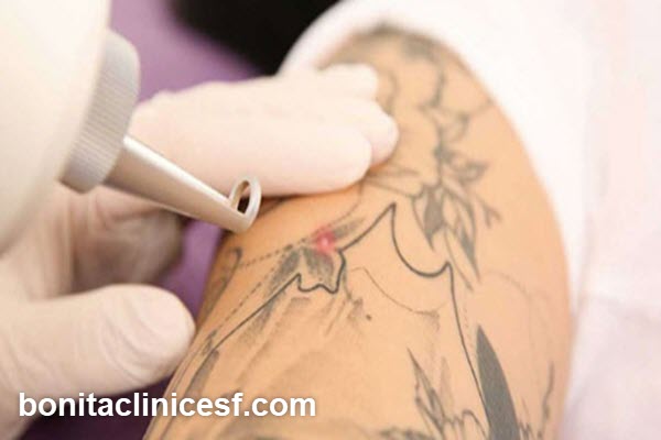 بهترین مرکز لیزر تاتو در اصفهان