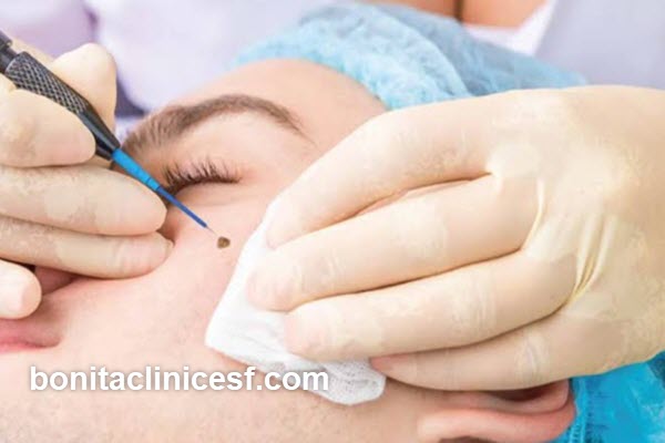 مراقبت های بعد از برداشتن زگیل با لیزر