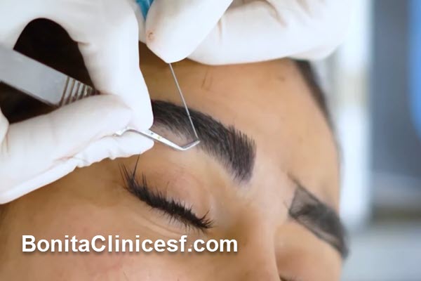 کاشت ابرو چگونه انجام میشود؟