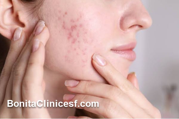 بهترین روش درمان لک صورت در اصفهان چیست؟