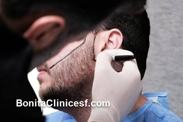 چرا انتخاب پزشک متخصص کاشت ریش و سبیل اهمیت دارد؟