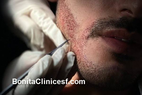پزشک متخصص کاشت ریش و سبیل در اصفهان